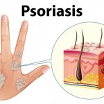 Psoriasis
