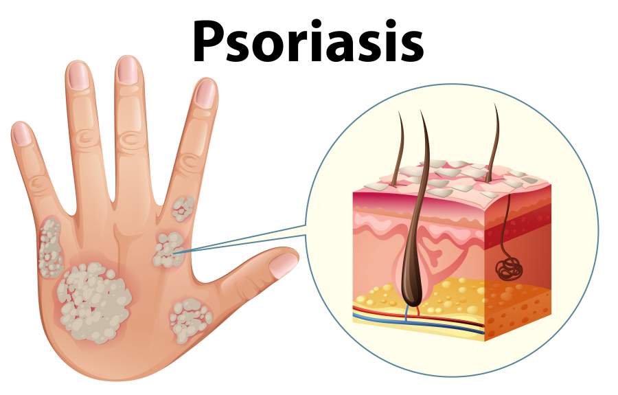 Psoriasis