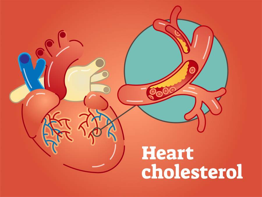 LDL Cholesterol
