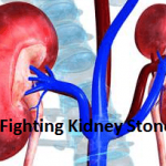 Fighting Kidney Stones