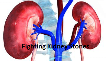 Kidney Stones