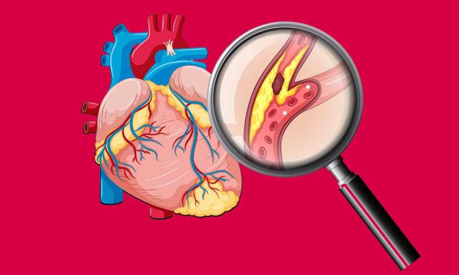 Lipid Profile Test in Indirapuram