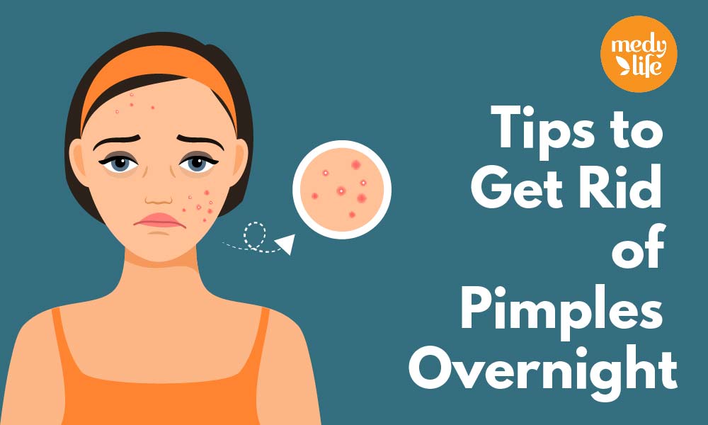Home Remedies for Pimples